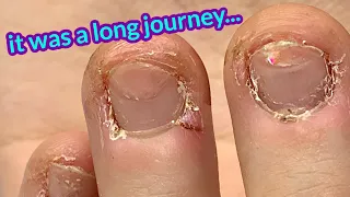 Bitten Nails Transformation - 2 years later! Anna's Last fill 😢