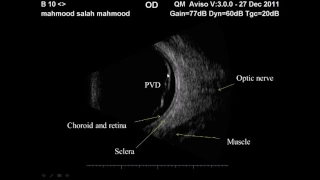 Ophthalmic ultrasonography : 1.Normal anatomy