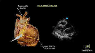 Basic cardiac ultrasound views I Dr. Koratala @NephroP