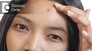 What are the types of Acne scars? - Dr. Deepak P Devakar