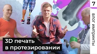 3D печать в протезировании. Реальный томский стартап!