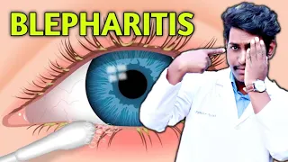 blepharitis ||blepharitis in hindi ||squamous, ulcerative, meibomianitis ||2021