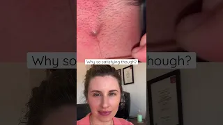 Biggest Ingrown Hair