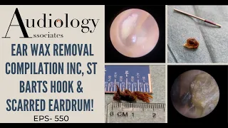 EAR WAX REMOVAL COMPILATION WITH ST BARTS HOOK AND SCARRED EARDRUM - EP550