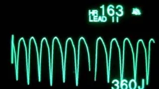 Pulseless Ventricular Tachycardia (pVT) - Monophasic Defibrillation at 360 Joules