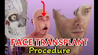 Face Transplant Surgery Procedure || medical 3d animation