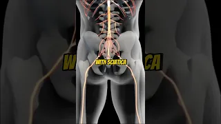 How To Fix Painful Sciatica