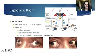 Lecture: Prescribing Prism for Diplopia in Neuro-Ophthalmic Disorders Part II