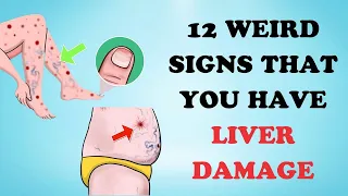 Warning: 12 Weird Signs That Show You're Having Liver Damage