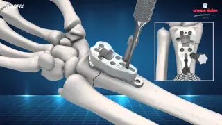 Distal Radius Plate VISIOFIX Concept & Surgical Technique 3D Animation