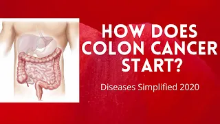 How Does Colon Cancer Start?