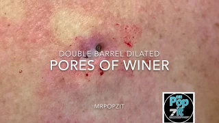 Double barrel blackheads Dilated pores of winer. Blackhead pop. Big squeeze. Cyst excision. Cyst pop