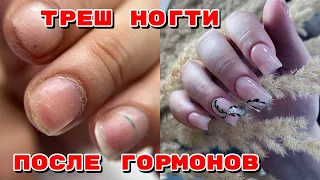 ТРЕШ НОГТИ ПОСЛЕ ГОРМОНОВ 😨 Наращивание за полтора часа 💅 Маникюр