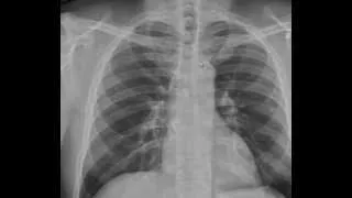 Introduction to the Chest Xray