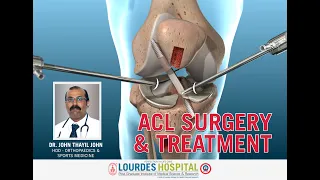 ACL Surgery & Treatment I Dr John Thayyil John, Lourdes Hospital,Kochi