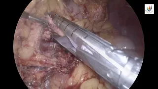 Spleen-preserving laparoscopic distal pancreatectomy with conservation of splenic vessel for Ins...