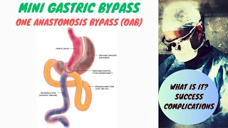 Mini Gastric Bypass | One Anastomosis Bypass (OAB)