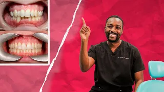 Smile Makeover Guide | Invisalign and Composite bonding cases