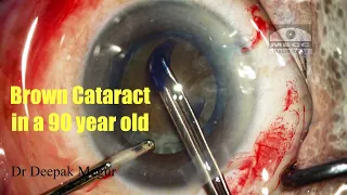 Hard Cataract In an elderly Patient - My Typical Strategies. Dr Deepak Megur.