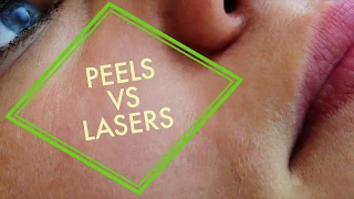 Peels Vs Lasers (2 Q&As with a Facial Plastic Surgeon)