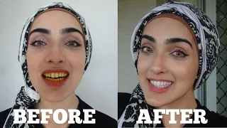 How To WHITEN Yellow Teeth NATURALLY & INSTANTLY AT HOME in 2 MINS | OIL PULLING ~ Immy