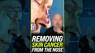 Removing Skin Cancer From the Nose 😱 #shorts