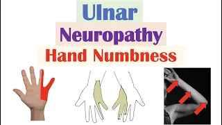 Ulnar Neuropathy (& Numbness in the Hand) | Causes, Signs & Symptoms, Diagnosis, Treatment