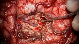 Resection of a Ruptured Spetzler-Martin Grade IV Lateral Frontal Arteriovenous Malformation