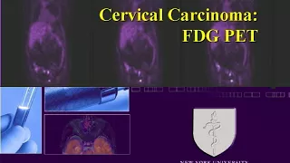 CT PET Imaging in Gynecologic Malignancies