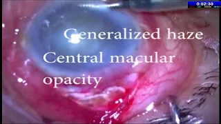 AIOC2020 GP131 T6 Dr Ruchi Goel SICS in Corneal Opacity