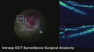 Image-guided Surgery in Severe Proliferative Diabetic Retinopathy