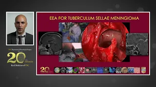 Minimally Invasive Cranial Tumor Neurosurgery in 2020