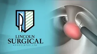 Polyp Removal - Dr. Deirdre Hart, Colon and Rectal Surgeon - Lincoln Surgical Associates, Shiloh, IL