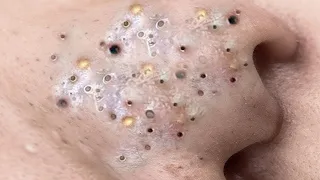 Make your Acne Treatment | Acne  spa  1035 | Acne  spa Treatment