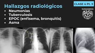 04.3 - Neumonía, TB, EPOC, Enfisema, Bronquitis, Bronquiectasias, Asma