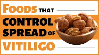 Foods that control spread of Vitiligo | Bharat Homeopathy