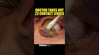 23 Contact Lens Stuck in Womans EYE 🤢 #shorts