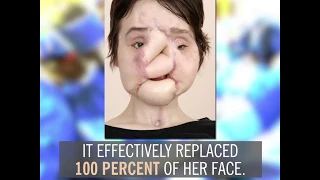 Katie Stubblefield's Face Transplant | By the Numbers