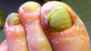 Ingrown Nail & Diabetic Foot Treatment!   Fungating Tumor Discussion