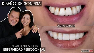 Diseño de Sonrisa en pacientes con Enfermedad Periodontal ¿Cómo se hace? - Odontología Láser.