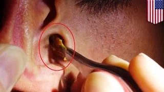 Ogromny kawałek woskowiny usunięty z ucha mężczyzny