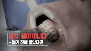 📌방송 하이라이트📌 발치, 끝이 아니다 - 뽑기 전에 알았다면 (KBS 20230208 방송)