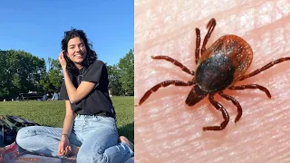 Quebec woman warning others about Lyme disease after late diagnosis | Tick safety