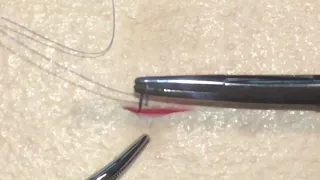 Punto di sutura semplice.