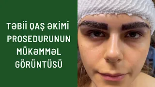 Təbii Qaş Əkimi prosedurumuzun mükəmməl görüntüsü👨‍⚕️👍