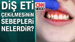 Diş eti çekilmesinin sebepleri nelerdir?