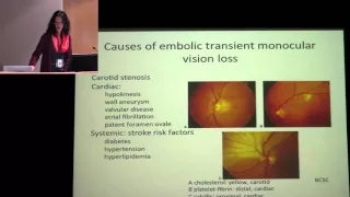 Transient Vision Loss due to Embolism or Vasculitis