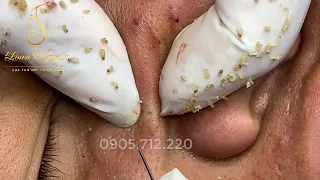 MEMORIES_remove BLACKHEADS 21 | Loan Nguyen