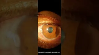 Ocular surface squamous neoplasia (OSSN)