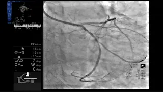 A complex LCX-OM bifurcation by Tak W. Kwan